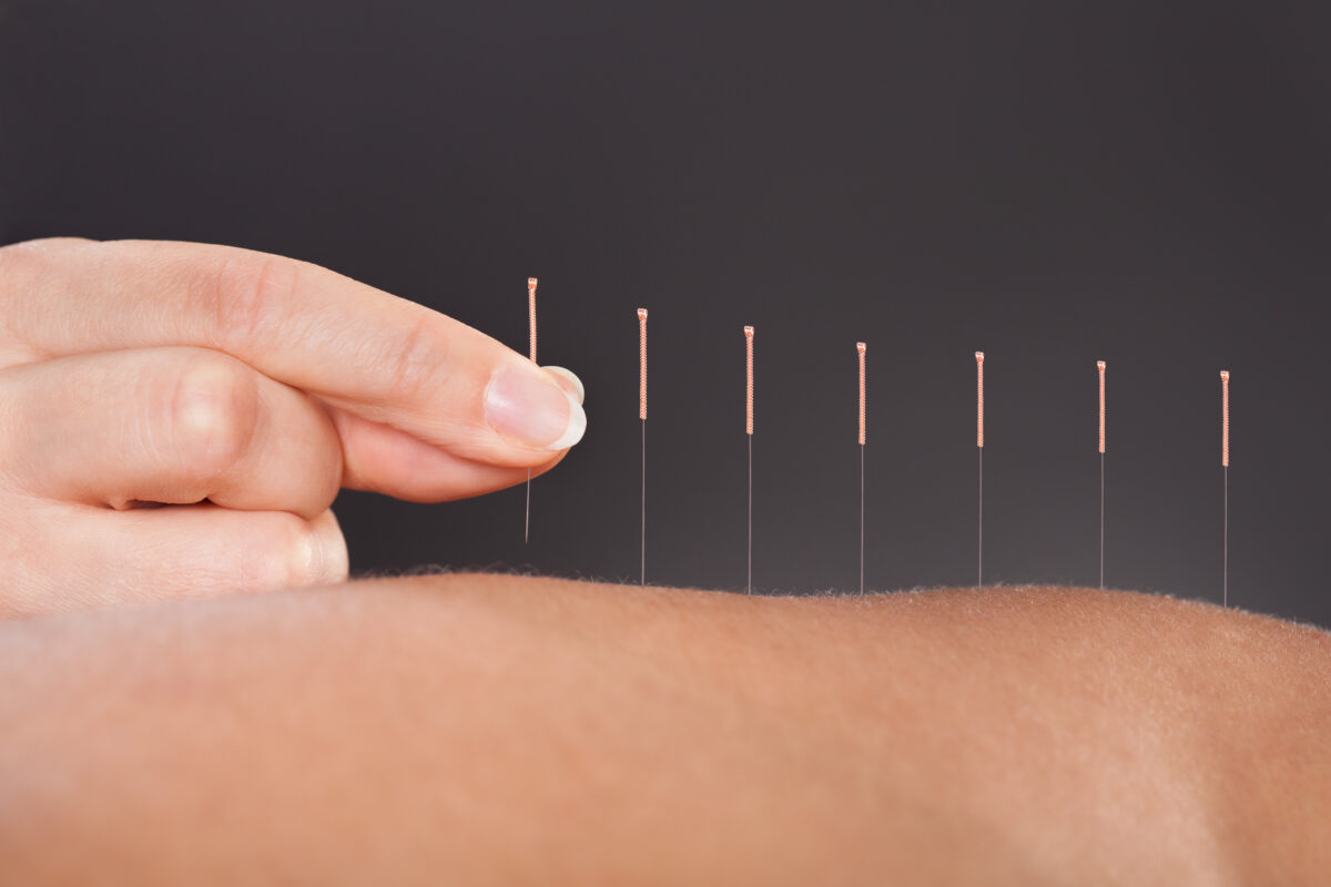 Agopuntura e moxibustione per trattare l’elettrosensibilit&agrave;